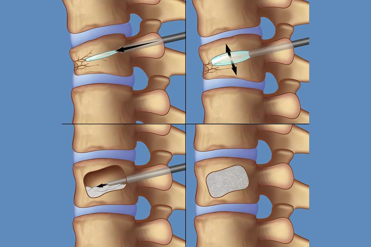 Cyphoplastie — traitement par ballonnet d'une fracture vertébrale